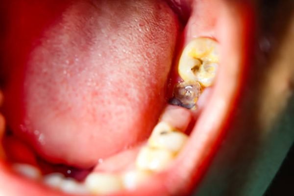 Gambar gigi berlubang/Foto iStock