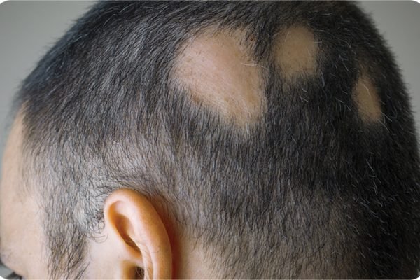 Ilustrasi pengidap alopecia areata/Foto : Dok. Freepik