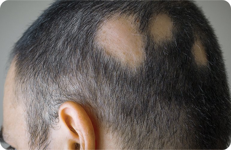 Ilustrasi pengidap alopecia areata/Foto : Dok. Freepik