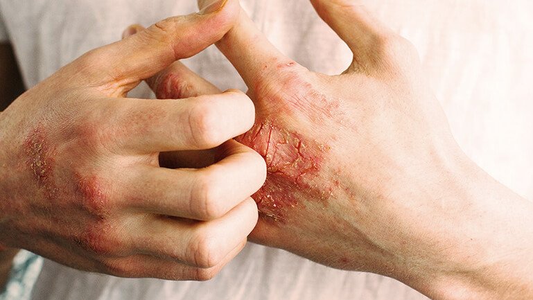 Ilustrasi penderita Neurodermatitis/Foto : Dok. Sanubiom